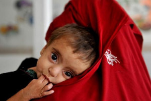 یونیسف: از هردو کودک افغان یک تن مصاب به سوءتغذیه است