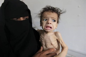 ۱.۸میلیون کودک یمنی با سوء تغذیه مواجه اند