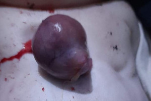 تولد یک نوزاد با قلب بیرون از بدن در کندز