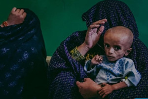 2.9 میلیون کودک در افغانستان دچار سوءتغذیه استند