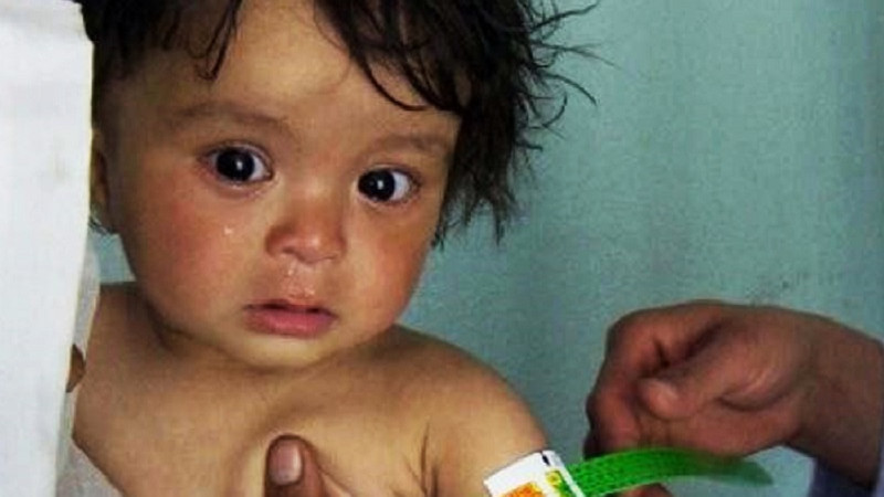 درخواست-کمک-مالی-فوری-یونیسف-برای-کودکان-در-معرض-سوءتغذیه-در-افغانستان