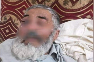 شیوع-بیماری-قارچ-سیاه-در-میان-افراد-مبتلا-به-کرونا