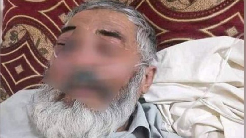 شیوع-بیماری-قارچ-سیاه-در-میان-افراد-مبتلا-به-کرونا